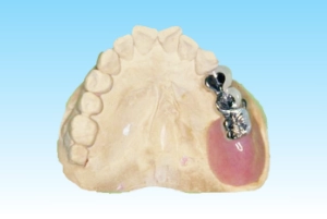 部分入れ歯スペシャルデンチャーの特長