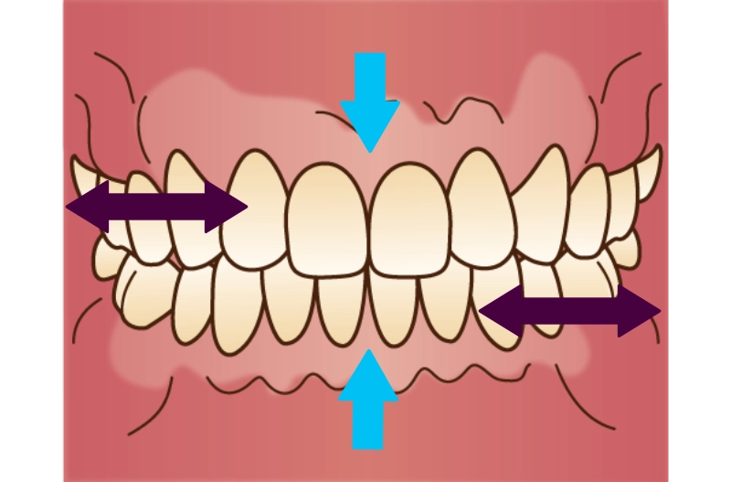 歯ぎしり・食いしばり検査