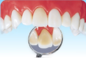 詰めもの・被せもの